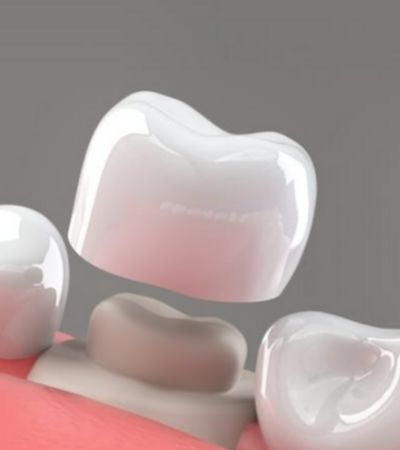 Dental Crowns & Bridges