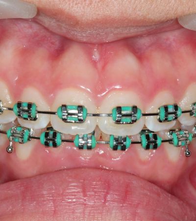 Orthodontic Treatments