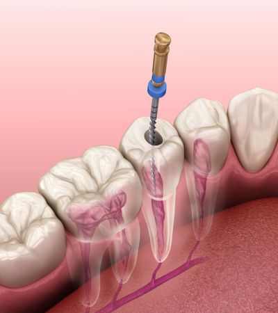 Root Canal Therapy