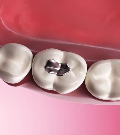 Tooth Coloured Fillings