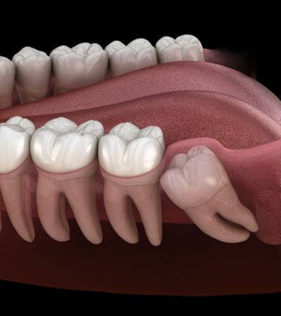Wisdom Teeth Extractions